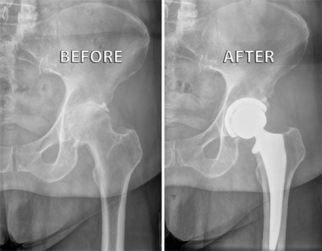 Total Hip Replacement Approaches