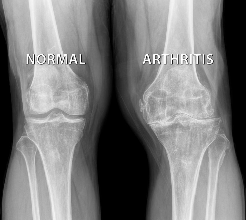 Diagnosis of Knee Arthritis