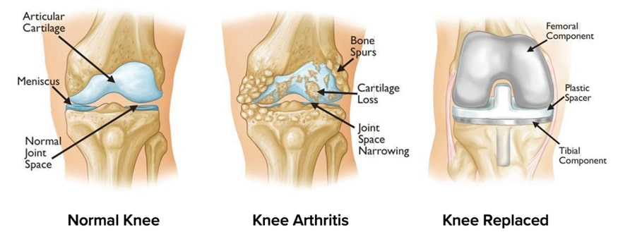 Total Knee Replacement