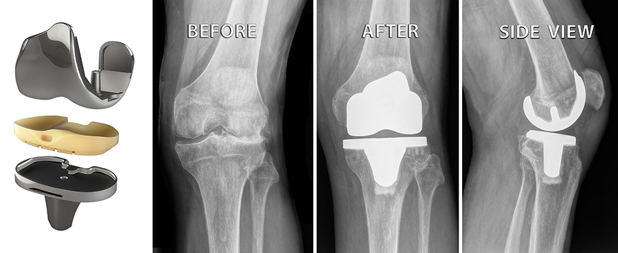Total Knee Replacement Procedure