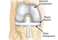 Total Knee Replacement