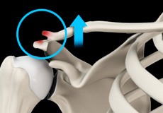 AC Joint Dislocation/Acromioclavicular Joint Dislocation