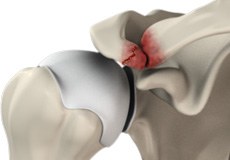 AC Joint Injury