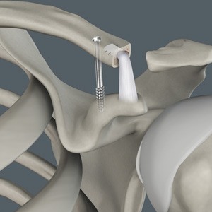 AC joint reconstruction_B