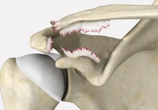 AC Joint Separation
