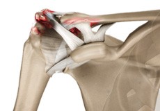 Acromioclavicular Arthritis