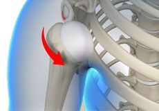 Anterior Shoulder Stabilization