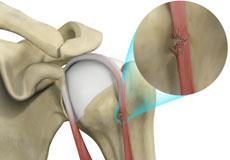 Biceps Tendon Rupture