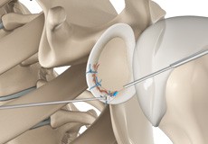 Bony Instability Reconstruction of the Shoulder