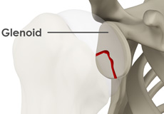 Glenoid Fractures