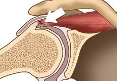 Internal Shoulder Impingement