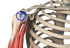 Long Head Biceps Tendon Rupture