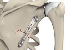 ORIF of the Scapula Fractures