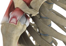 Partial Rotator Cuff Tear