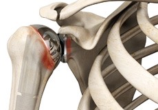 Periprosthetic Shoulder Infection