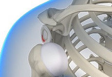 Posterior Shoulder Stabilisation