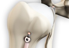 Proximal Biceps Tenodesis