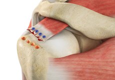 Revision Rotator Cuff Surgery