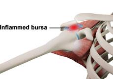 Rotator Cuff Bursitis