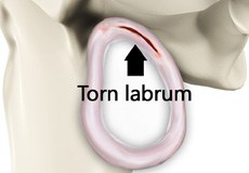 Shoulder Labral Tear