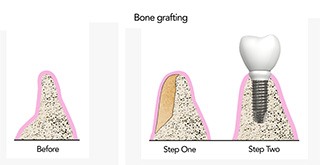 Bone Grafting