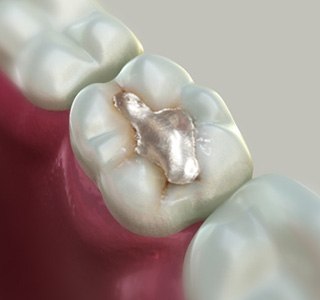 Composite Fillings