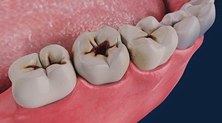 Dental Cavities/Dental Caries