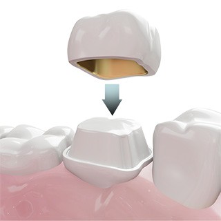 Dental Crown (Cap)