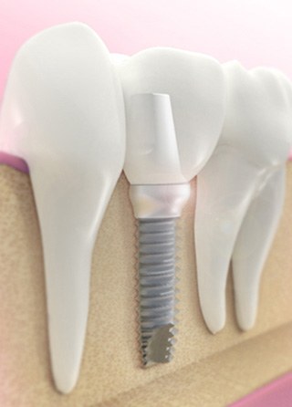 Dental Implant