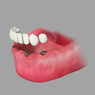 Full-Arch Replacement