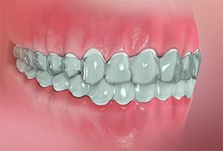 Invisalign