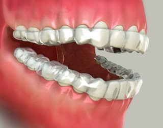 Mouth Guards