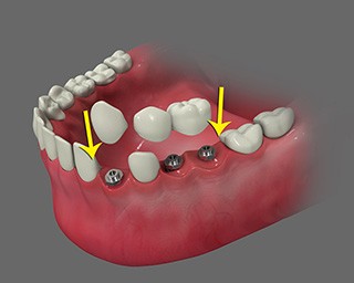 Multiple Teeth Replacement