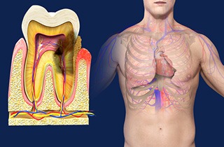Periodontal Disease, Heart Disease and Stroke