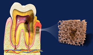 Periodontal Diseases