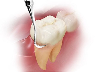 Periodontal Scaling and Root Planing