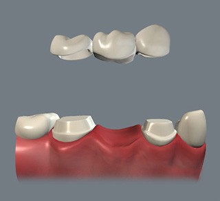 Single Tooth Replacement
