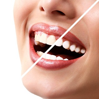 Teeth Whitening