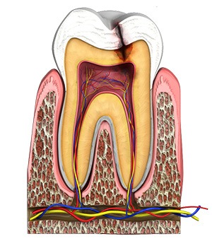 Tooth Decay