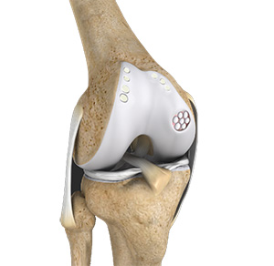 Cartilage Replacement
