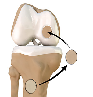 Chondroplasty