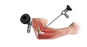 Elbow Arthroscopy