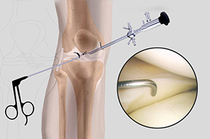 Knee Arthroscopy