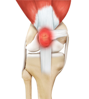 Kneecap Bursitis