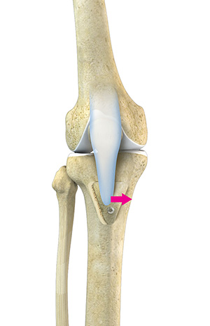 Patellofemoral Realignment