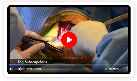 Lesser Tuberosity Osteotomy in Anatomic Total Shoulder Arthroplasty