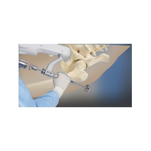 Mako Robotic-Arm Assisted Technology for total hip replacement