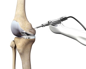 Mako SmartRobotics for Partial Knee Replacement