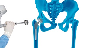 Mako SmartRobotics for Total Hip Replacement
