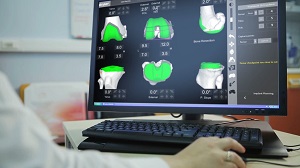Mako SmartRobotics for Total Knee Replacement